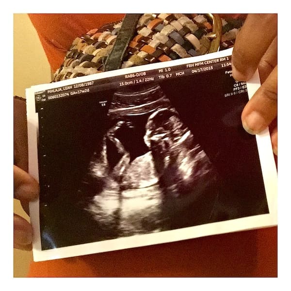 When An Amniocentesis Becomes Your Saving Grace | Twin Cities Familys Blog