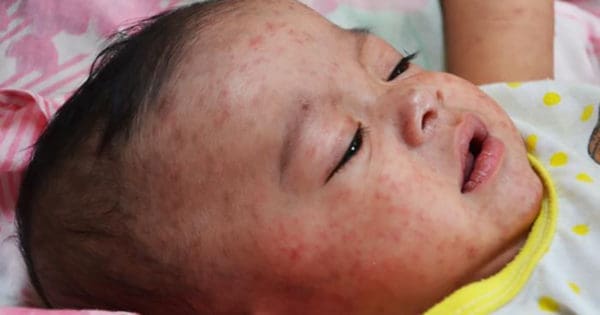Why Measles Is A Big Deal | Twin Cities Familys Blog