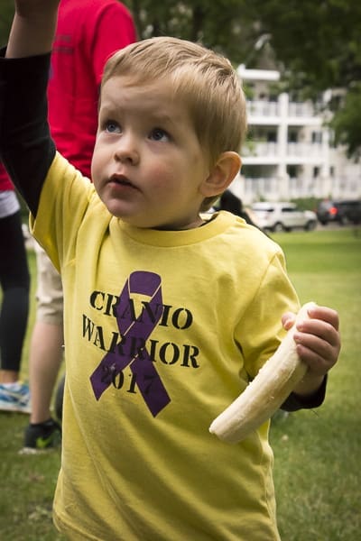 What is Craniosynostosis? | Twin Cities Familys Blog